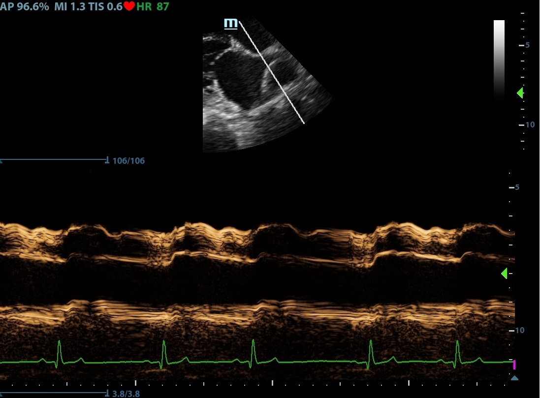 Valoración en modo M del ratio vena pulmonar / arteria pulmonar.