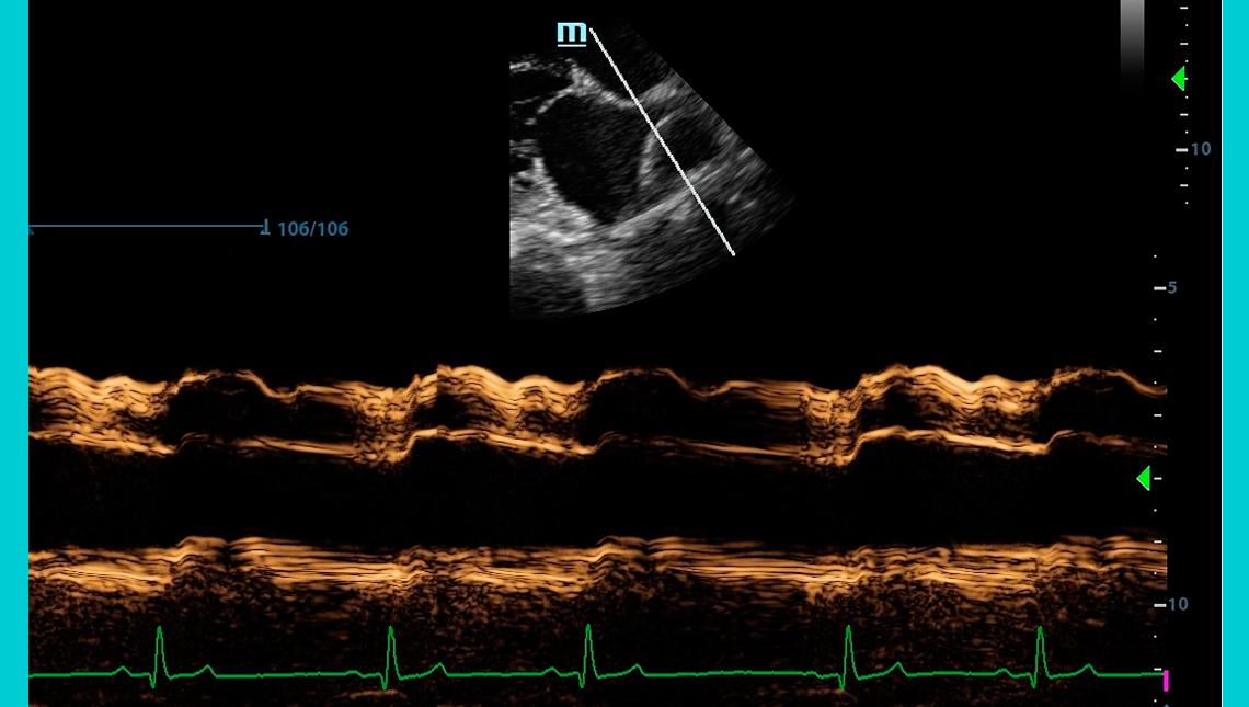 Hipertensión pulmonar